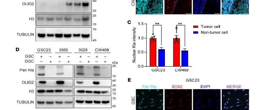 【文献分享】乳酸通过cbx3调节组蛋白乳酸化重编程胶质母细胞瘤免疫