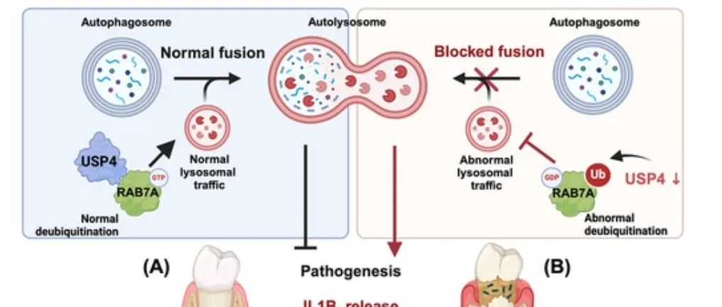 Autophagy | 浙江大学丁佩惠团队揭示USP4通过自噬调控牙周炎进展中的机制