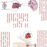 Stroke：TCD发泡试验在隐源性卒中的应用（一）