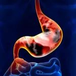 《柳叶刀》子刊：死亡风险直降18%，62%患者客观缓解！晚期胃癌一线治疗新选择