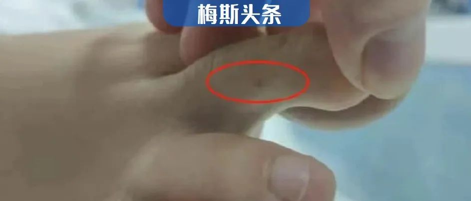 被蛇咬伤身亡、涉事医生停职、三亚卫健委再发通报！广东三甲主任发声：毒蛇日益泛滥，但不是每家医院都有血清，医生普遍缺乏救治经验
