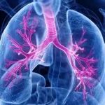 高危肺癌患者无病生存率达96%！《柳叶刀》子刊：新策略大幅减少复发