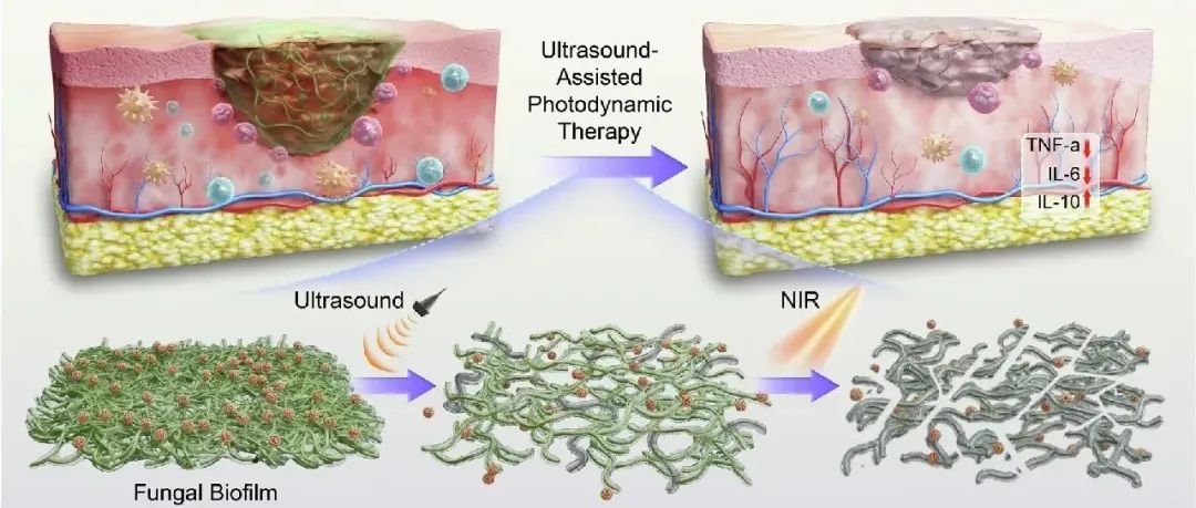 【Nat.Commun】超声辅助半导体敏化上转换光动力疗法根除真菌生物膜感染
