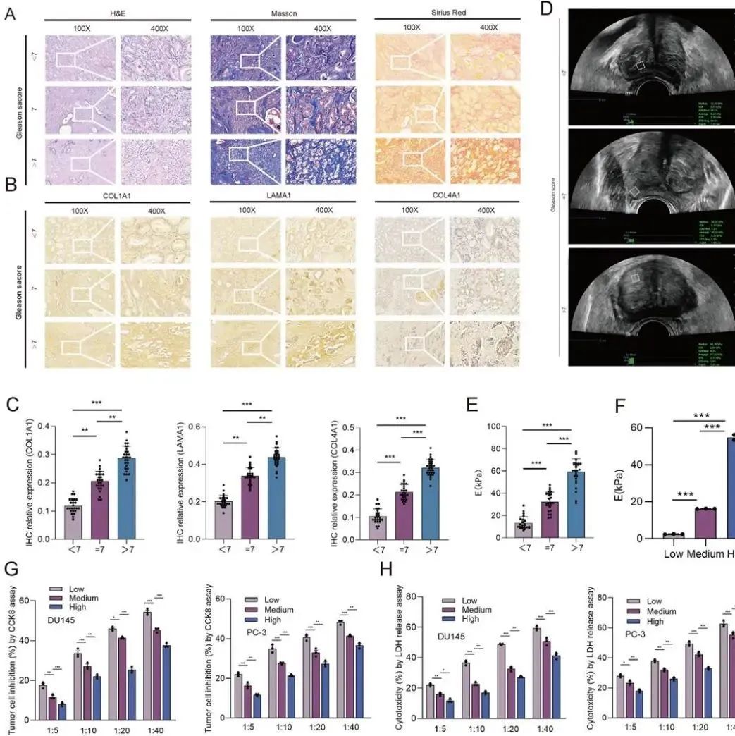 Cell Death Dis | 福建医科大学附属第一医院泌尿外科许宁/薛学义团队揭示高硬度基质助力前列腺癌免疫逃逸新机制