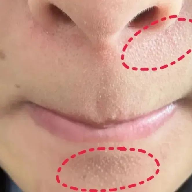 真的想问：下巴凸起的小颗粒，到底是什么呀？