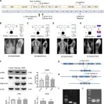 eLife | 北京协和医院吴南等团队研究发现EPHA4信号失调与异常运动和特发性脊柱侧弯的发展有关