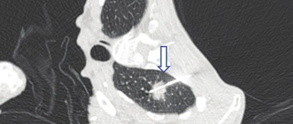 Radiology: 重温经典—经皮肺穿刺并发症的PEARL综合防治方法