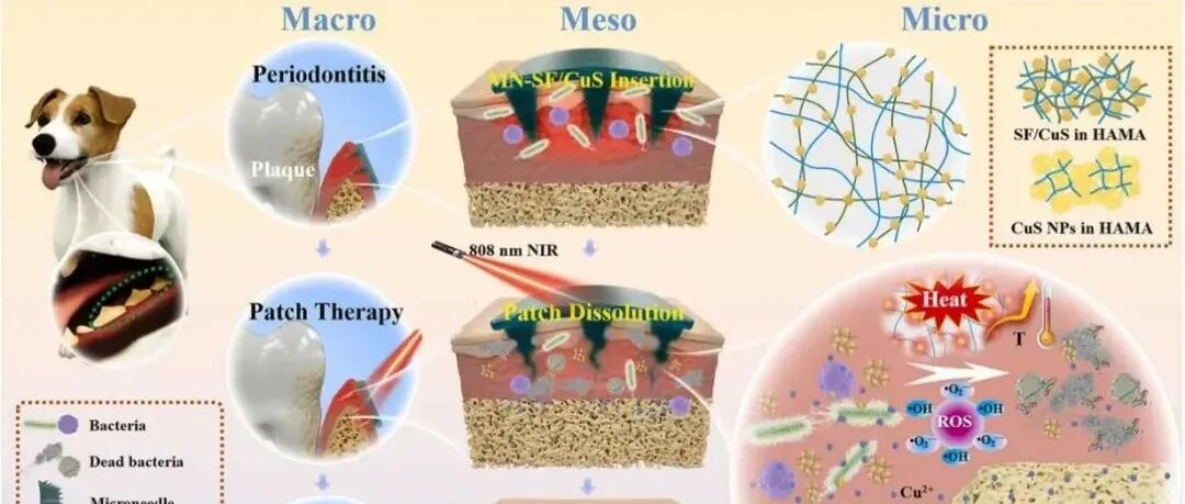 《Nano Today》：多功能丝素纳米酶复合微针，实现可控光疗杀菌，高效治疗牙周炎
