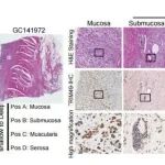 Cancer Res丨陆军军医大学王斌/卞修武等发现调控胃腺癌侵袭的新机制