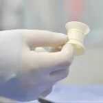 支架法肠转流术如何革新直肠手术 | 推广