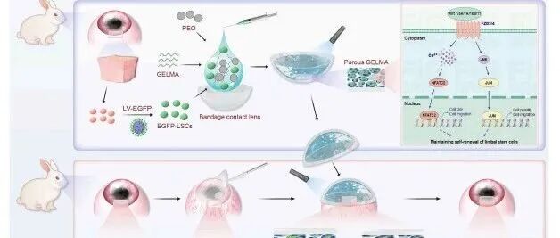 厦门大学：基于多孔GelMA水凝胶递送角膜缘干细胞治疗角膜缘干细胞缺乏症