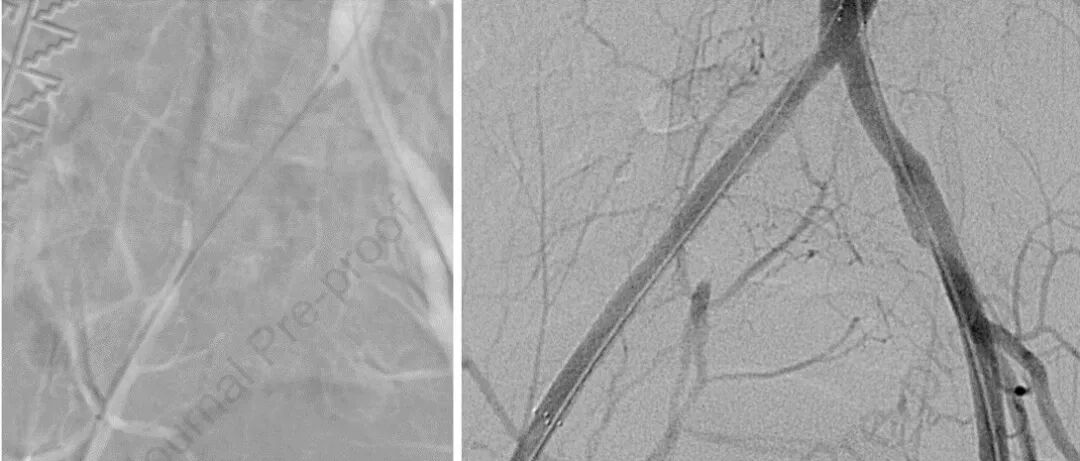 JVIR｜髂股腘动脉的急性闭塞，直接压支架也行 ！