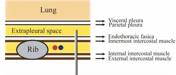 ER｜胸膜麻醉能有效减轻经皮肺穿刺时的疼痛