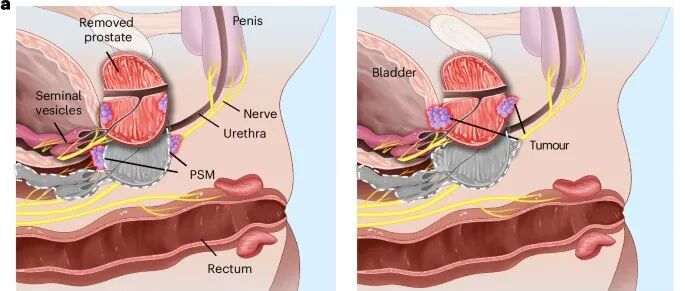 文献分享 | Nat. Biomed. Eng. | 通过组织pH值和前列腺特异性抗原活性对前列腺肿瘤原位分级的无标记导航系统
