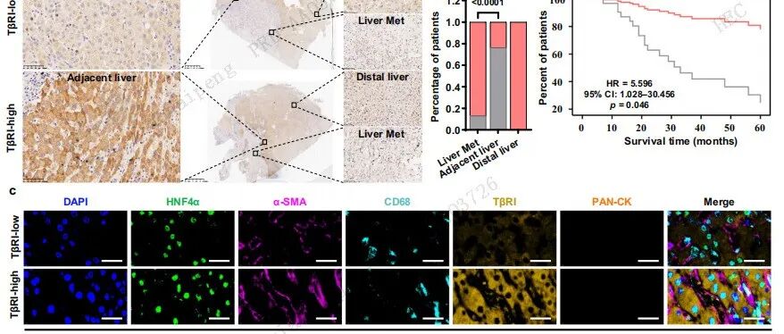 南方医科大学发现肿瘤肝转移免疫新靶点—TGF-βRI/Galectin-9轴