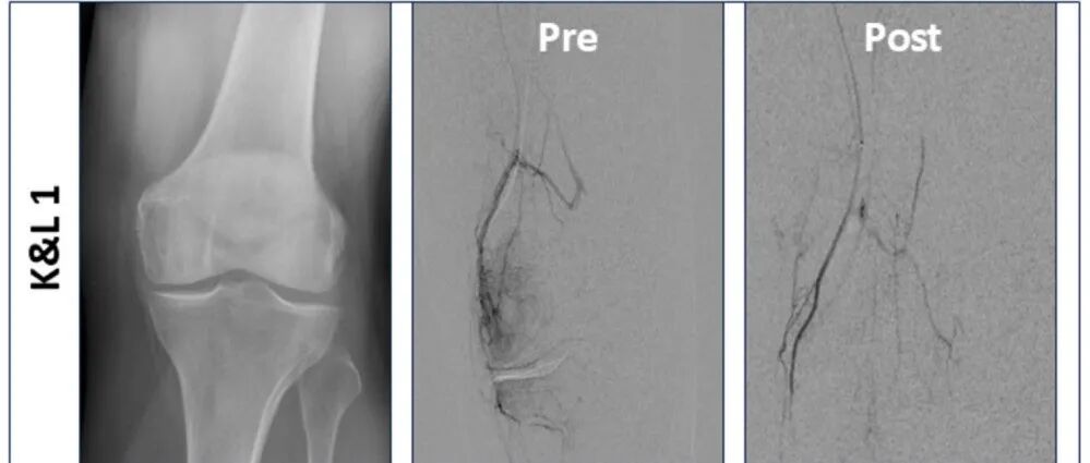 CVIR | 明胶微球也可行膝动脉栓塞治疗膝关节炎