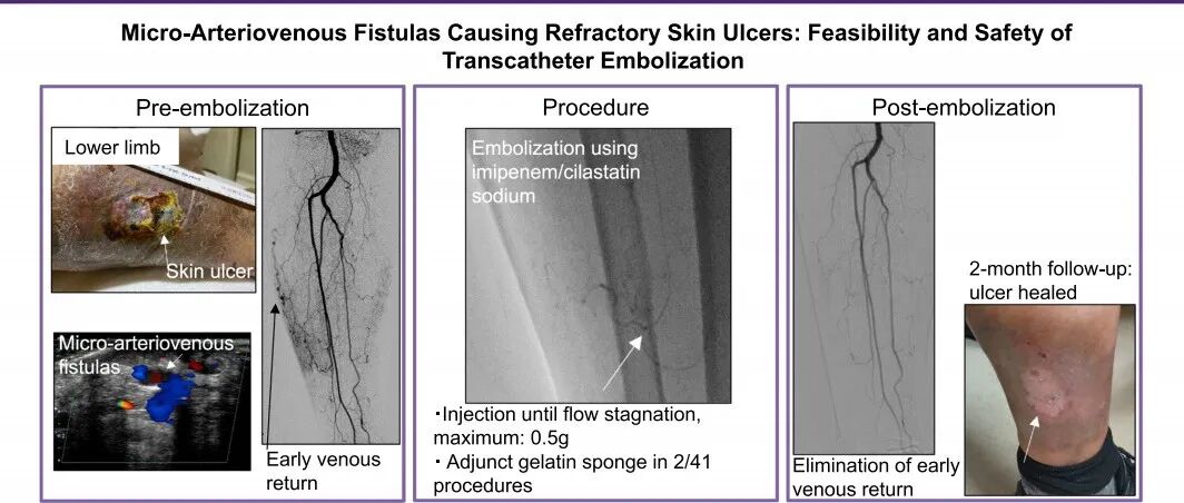 CVIR | 介入栓塞治疗下肢动静脉微小瘘：难治性皮肤溃疡的另一个元凶