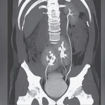 男子因尿路感染就医，然后发现自己多了一个肾