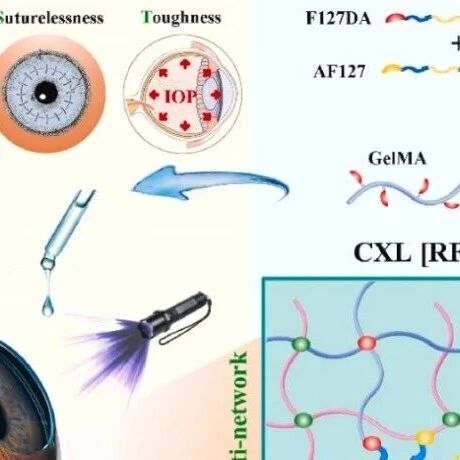 《Bioactive Materials》：如何利用光固化水凝胶实现角膜无缝修复？