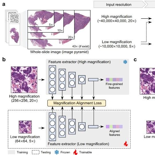 Cancer Res｜南方医科大学刘再毅等团队破解AI病理“慢、贵、难”落地难题：新框架大幅提速增效，让术中快速精准诊断成为可能