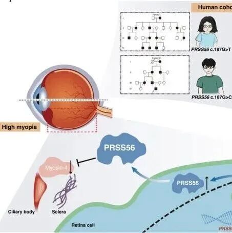 Cell Res | 复旦大学王红艳团队揭示PRSS56非编码变异致轴性高度近视的分子机理及干预策略