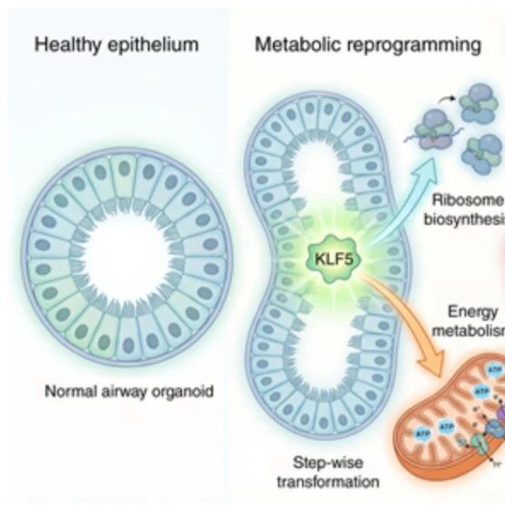 Cancer Res｜利用类器官重现癌变之路！复旦大学林鑫华等团队鉴定KLF5为肺鳞癌起始关键因子，并揭示其独特作用机制