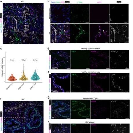 Adv Sci：复旦大学姜宁等团队发现激活ERBB4信号是纠正异常修复、对抗纤维化的关键