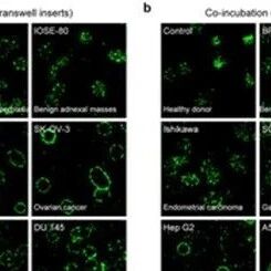 Adv Sci | 血液中的“诊断暗盒”！华中科技大学张玉慧等团队发现血小板藏有肿瘤“指纹”，看形态就能精准识别癌症