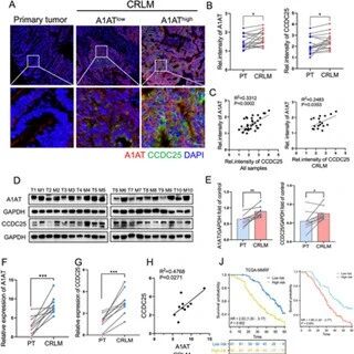 Adv Sci | 肿瘤转移的“合谋”！中国医科大学张敬东等团队发现癌细胞蛋白A1AT可“策反”中性粒细胞设下陷阱，并武装自身以穿越