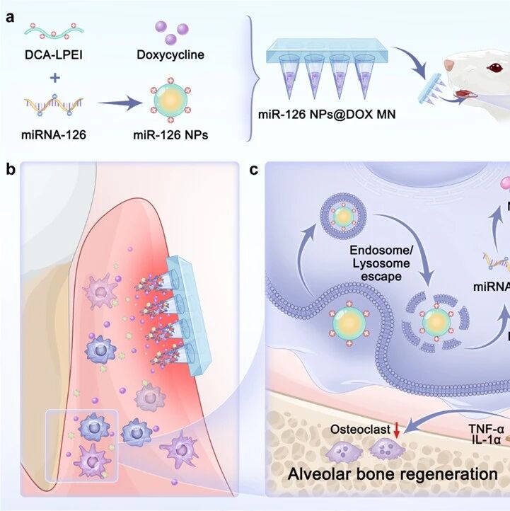 ACS Nano：靶向ROS/NF-κB通路的多功能微针平台用于牙周炎免疫调节治疗