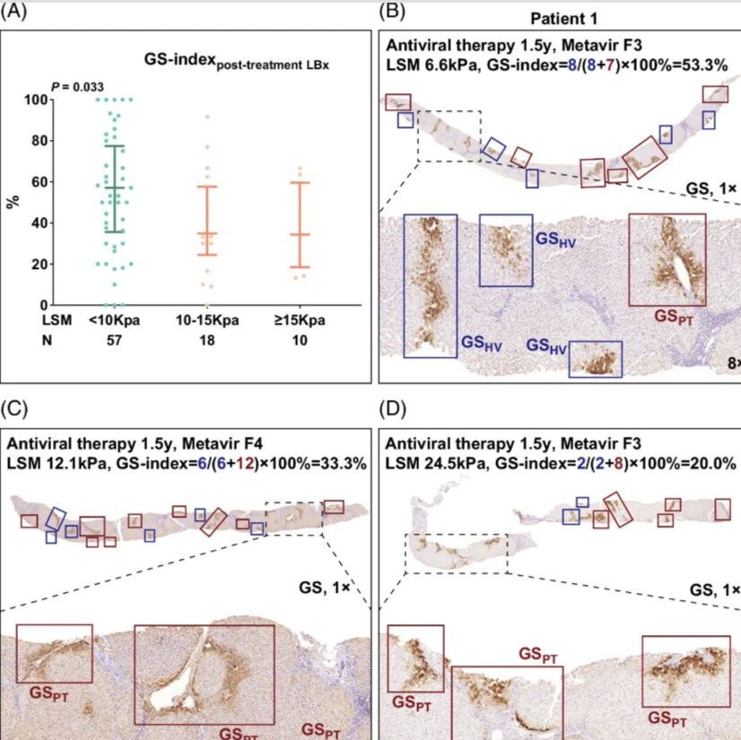 Hepatology | 首都医科大学吴晓宁/尤红发现肝脏硬度测量可预测伴有显著肝纤维化或肝硬化的慢性乙型肝炎患者的肝脏相关事件