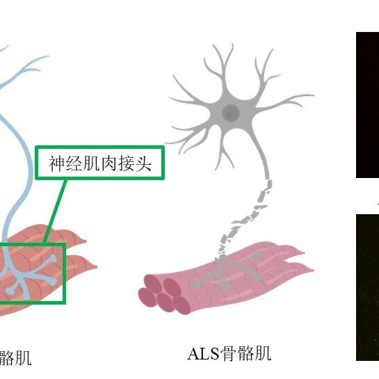 【科学普及】双管齐下，能拖住“渐冻”的步伐吗？