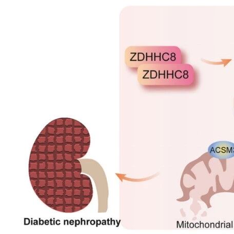 Cell Death & Differ | 糖尿病肾病的“多米诺骨牌”：中南大学贺理宇团队发现一个棕榈酰化标签引发线粒体崩溃
