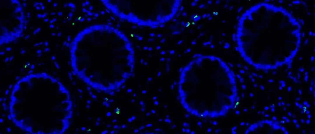 【封面】"长新冠"患者的成像显示：新冠病毒RNA和活化T细胞可持续存在数年！《科学·转化医学》